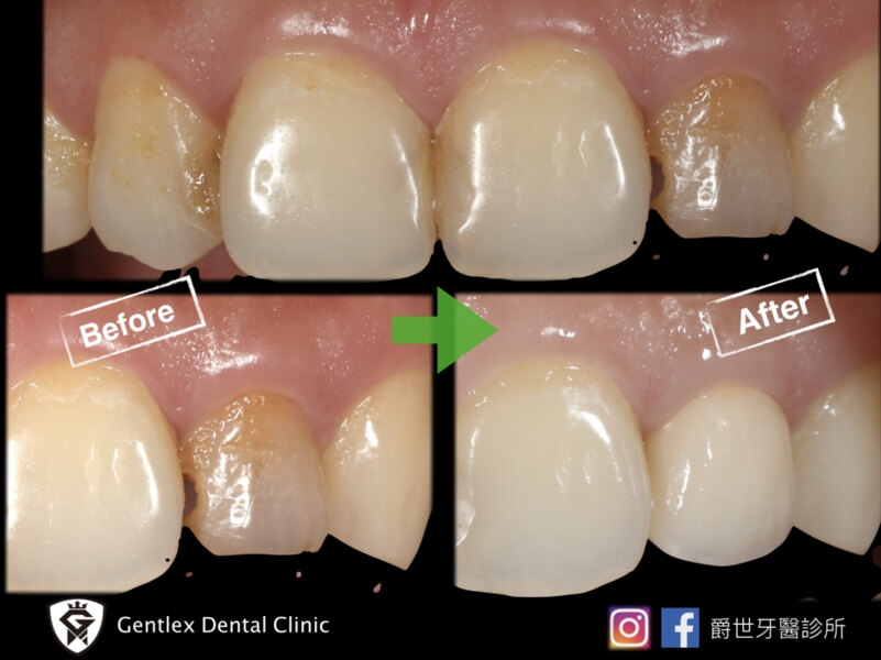 單顆假牙的製作，要考慮諸多細節