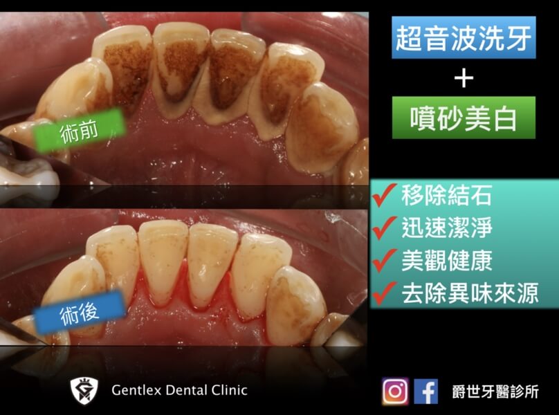 噴砂美白 噴砂美白