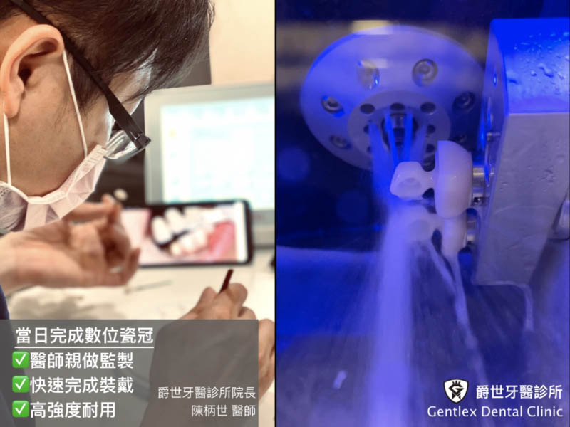 數位當日完成全瓷冠