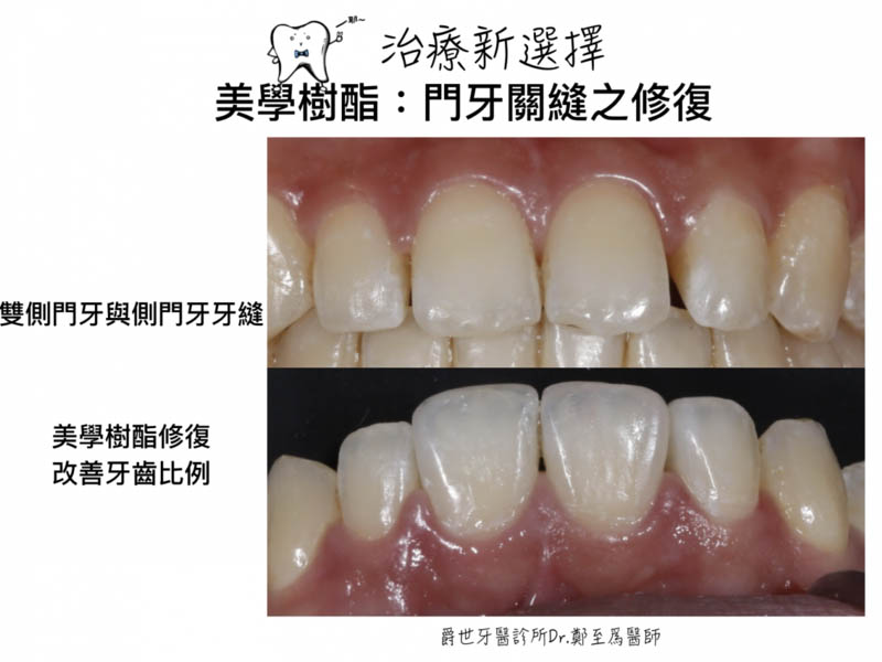 前牙美學樹脂補牙