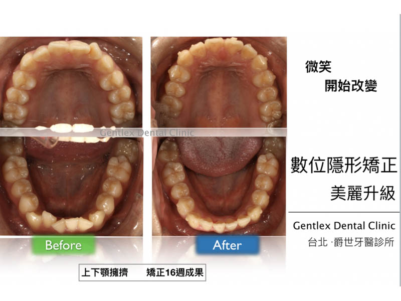 數位隱形矯正 隱適美矯正系統