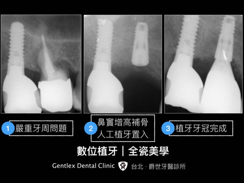 上顎竇增高術 補骨植牙