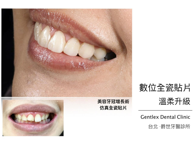 美學全瓷貼片