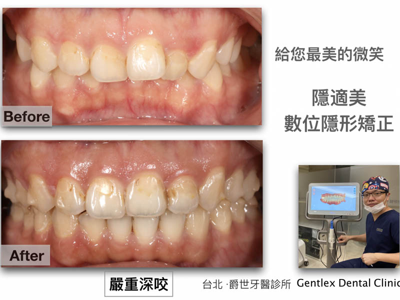 隱形矯正 改善深咬