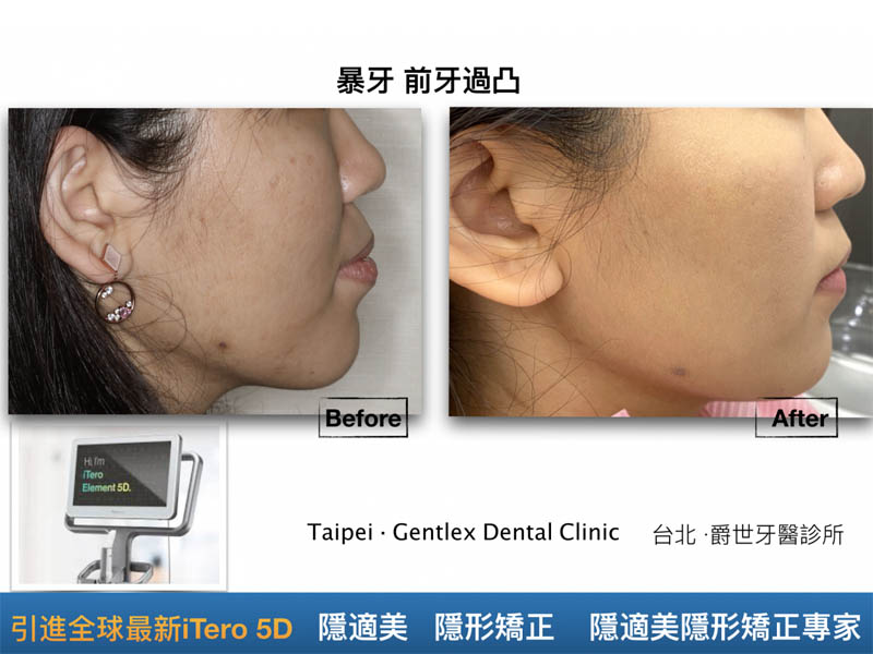 矯正改善暴牙嘴凸