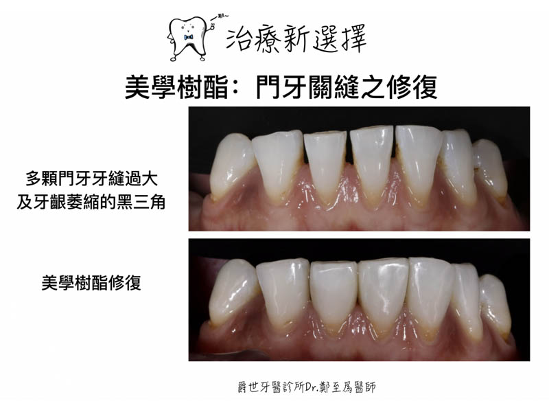 前牙美學樹脂復形