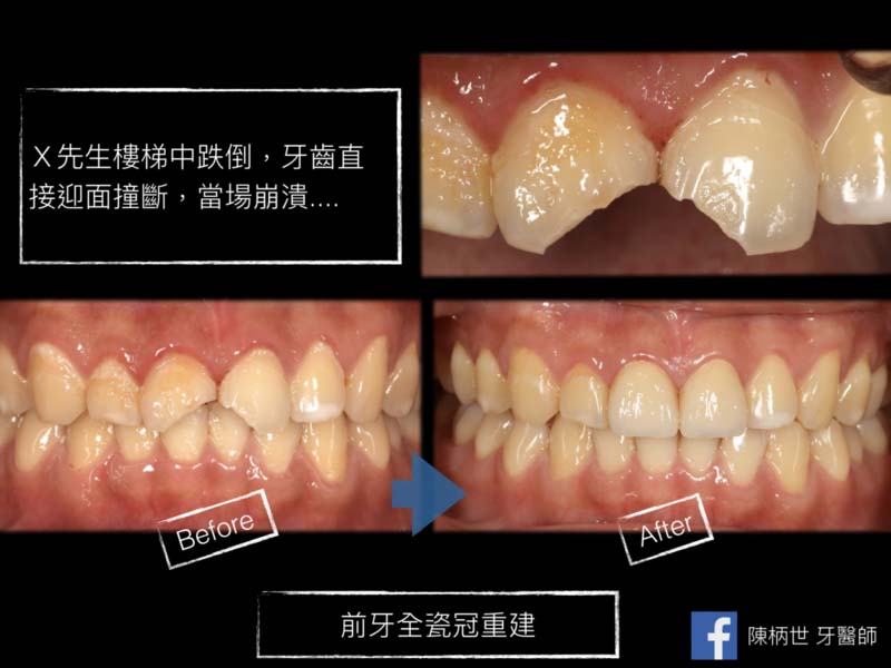 前牙缺損重建