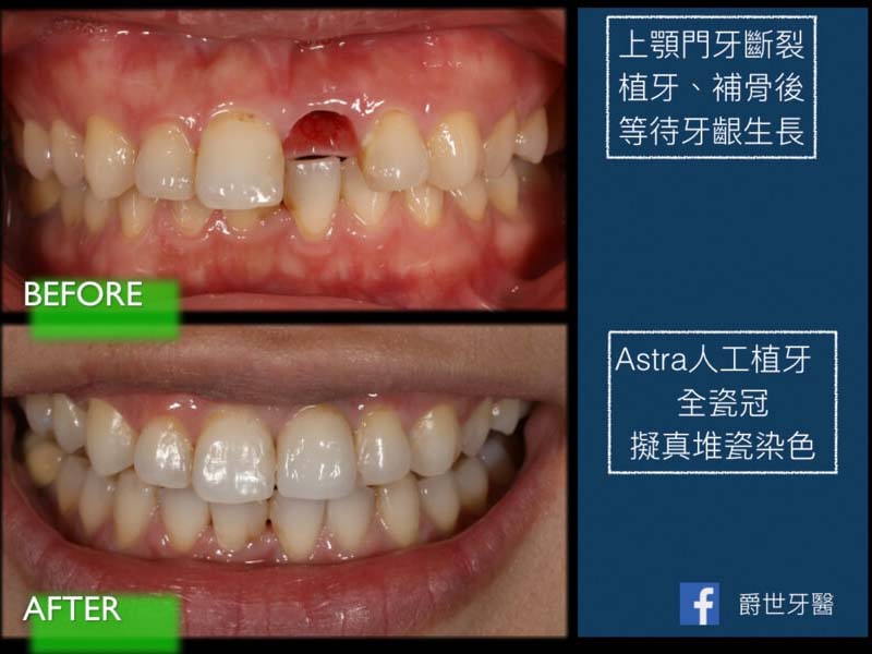 前牙植牙