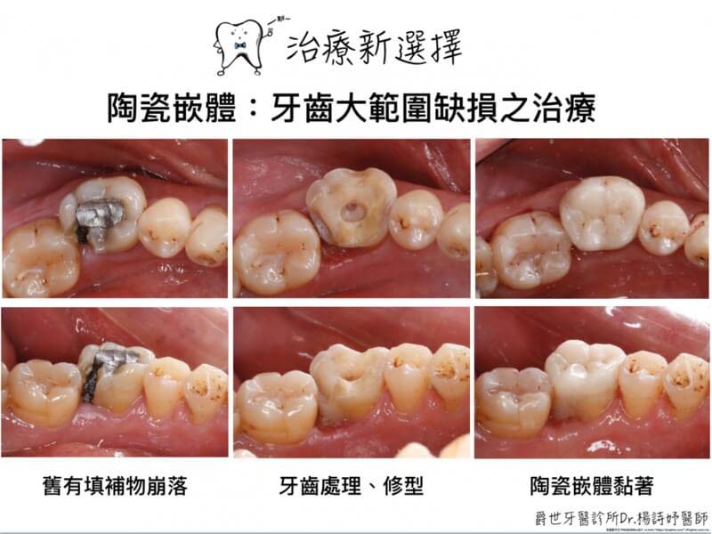 後牙全瓷美學重建