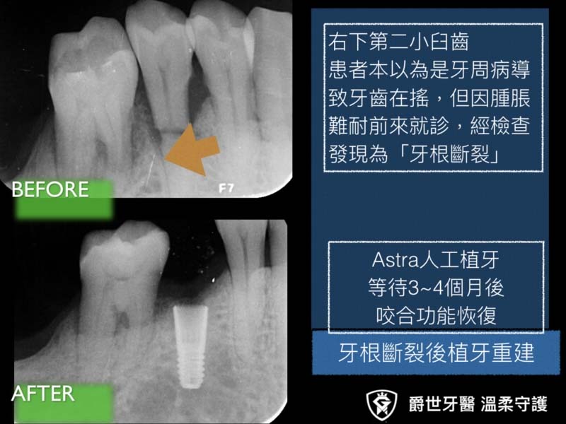 牙根斷裂，植牙咬合重建