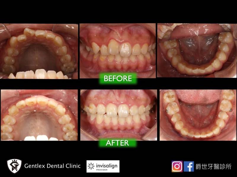 隱適美隱形矯正