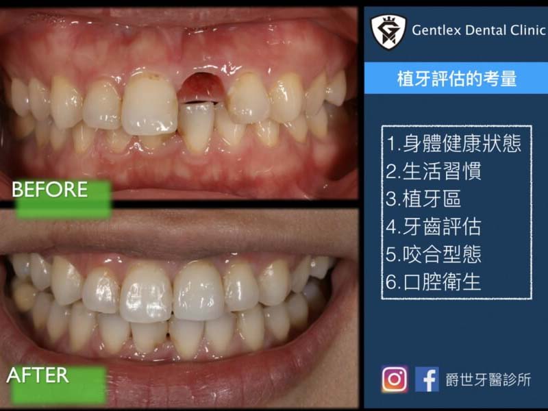 植牙成功率多少？