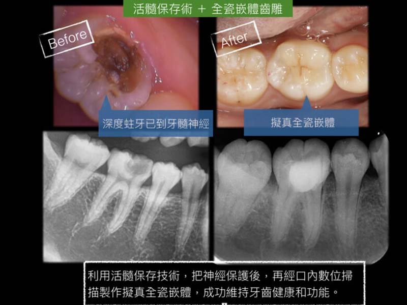 活髓保存＋微創全瓷美學修復