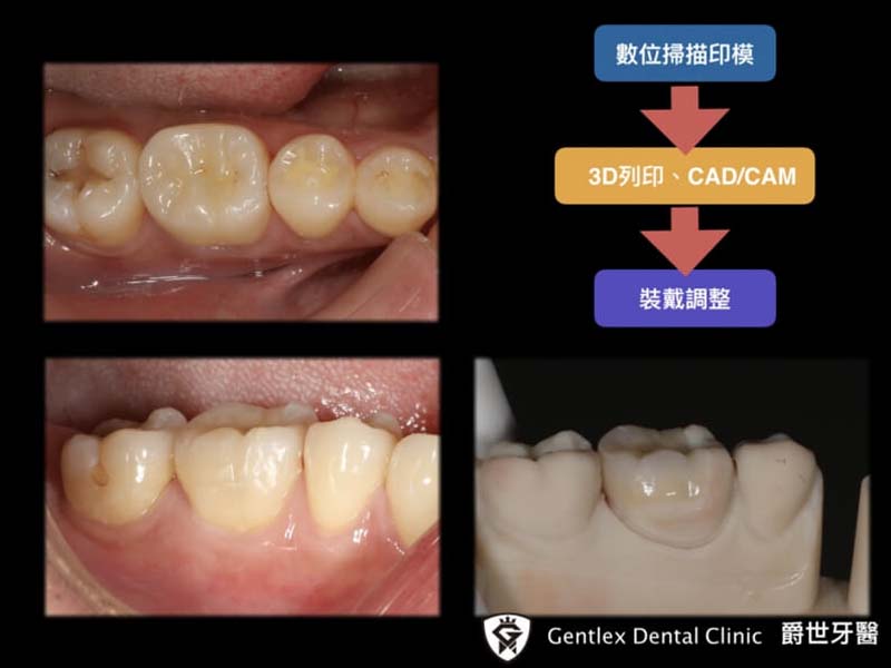 微創全瓷美學修復