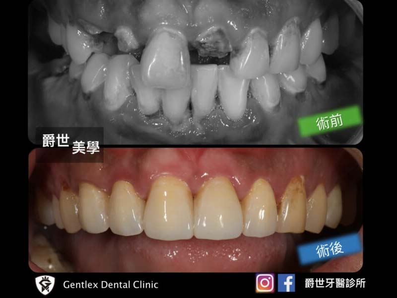 文章新知 全瓷美學重建