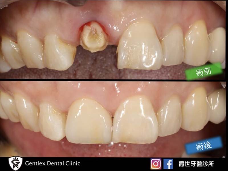 前牙牙冠斷裂全瓷重建