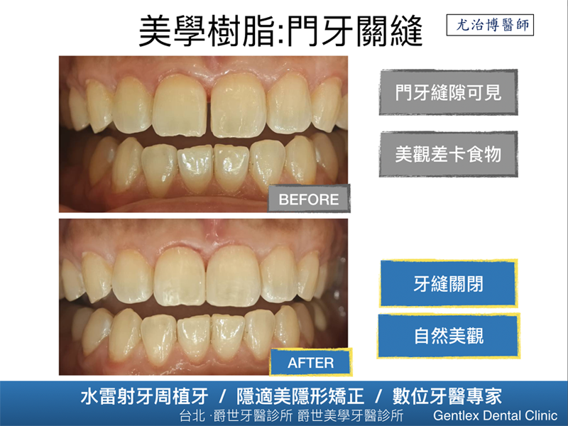 美學樹脂：門牙關縫