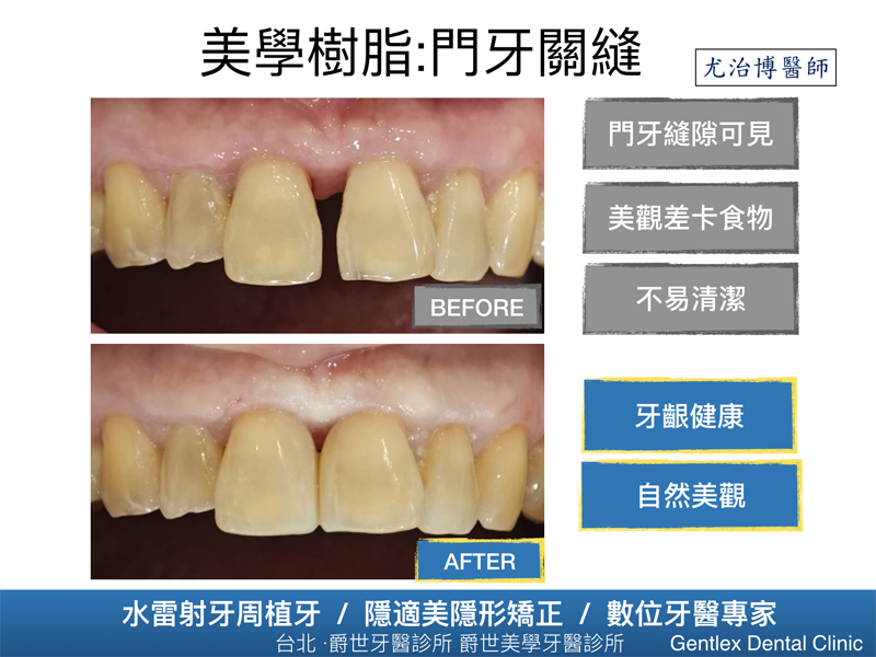 美學樹脂：門牙關縫