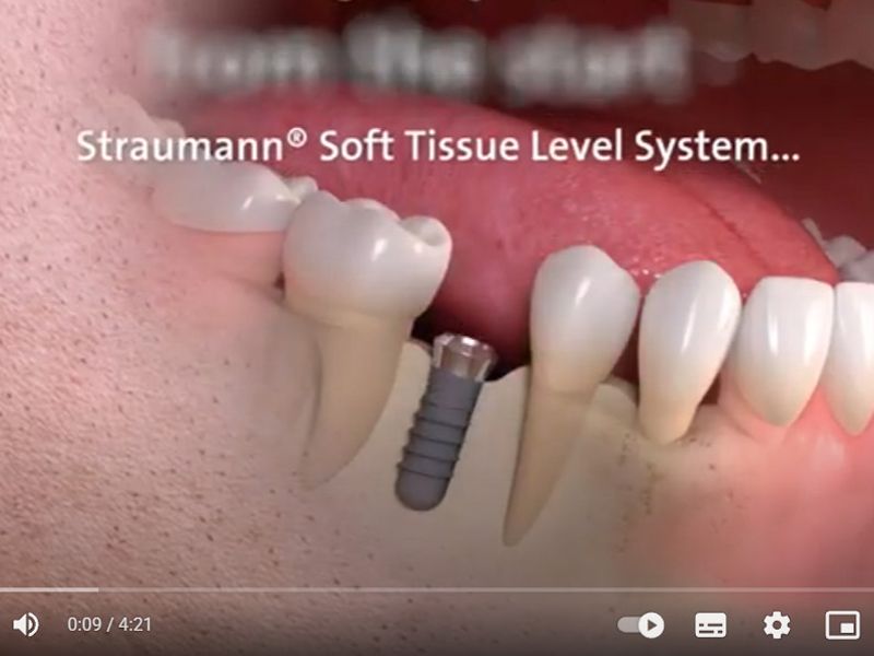 植牙全攻略：6步驟從評估到裝牙
