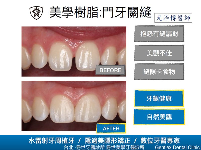美學樹脂：門牙關縫