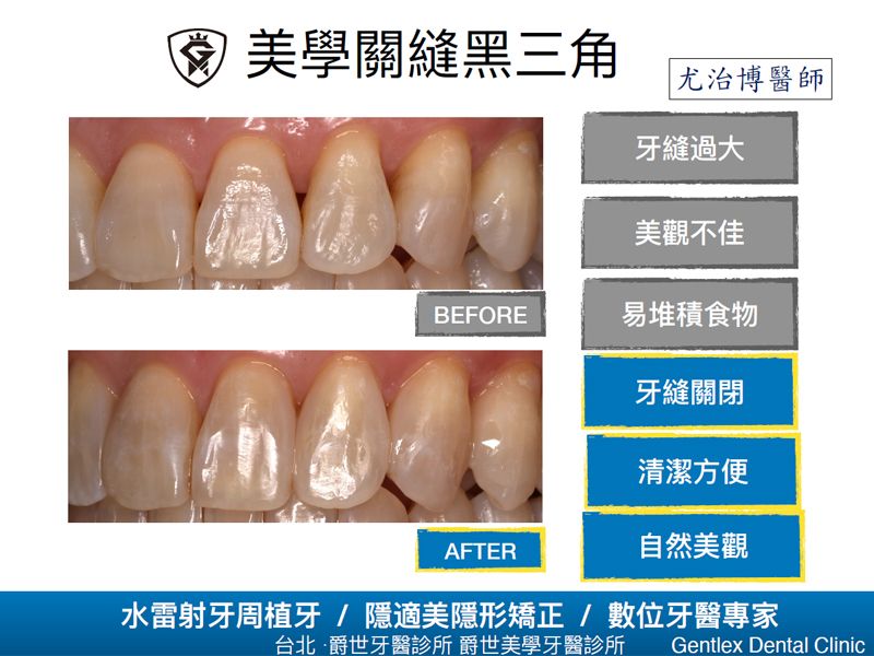 美學關縫黑三角