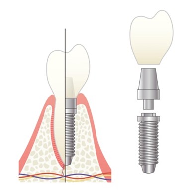 植牙跟一般假牙有什麼不同？