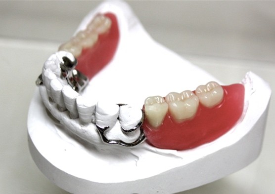 植牙跟一般假牙有什麼不同？