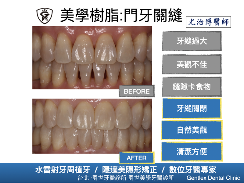美學樹脂:門牙關縫
