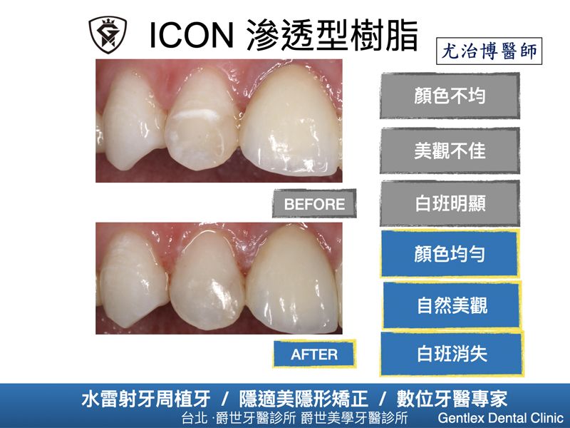 ICON 滲透型樹脂