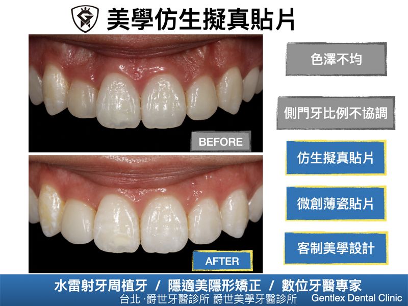 美學仿生擬真貼片