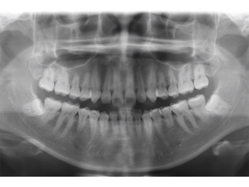 我該拔智齒嗎？陳柄世醫師告訴您～