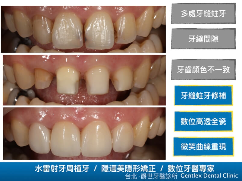 數位全瓷假牙微笑重現