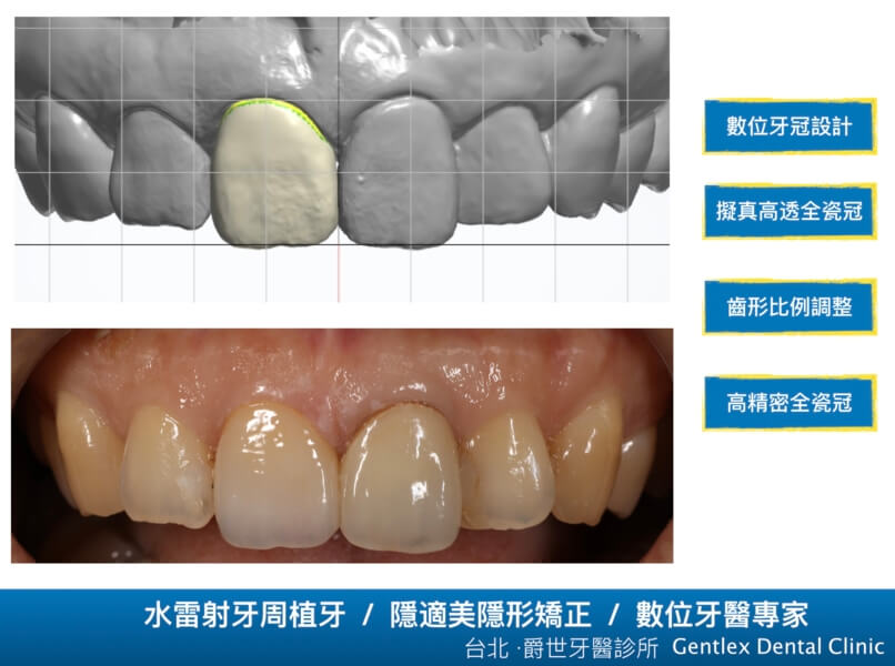正中門牙數位美學全瓷