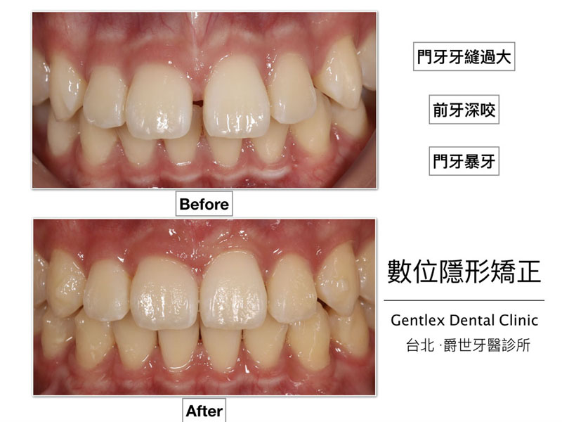 隱適美隱形矯正