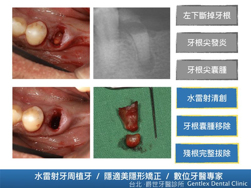 水雷射拔牙移除根尖發炎