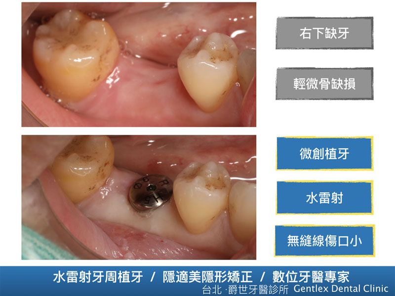水雷射微創植牙