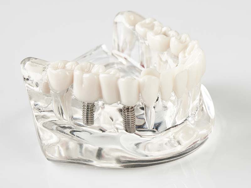 植牙後多久可以裝假牙？