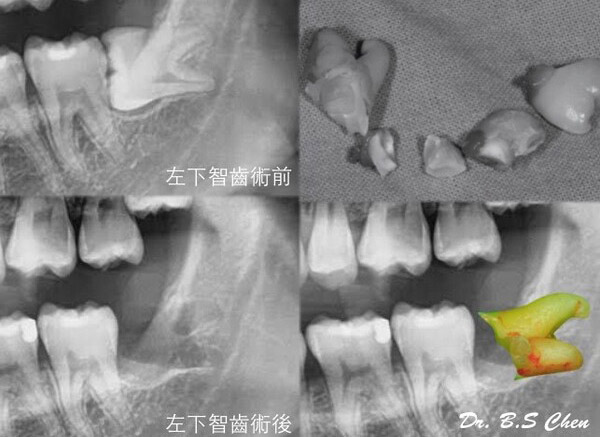 微創智齒手術案例分享
