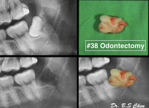 微創智齒手術案例分享