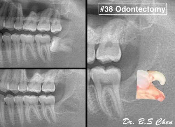 微創智齒手術案例分享