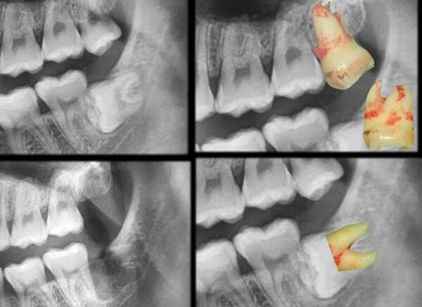 微創智齒手術案例分享