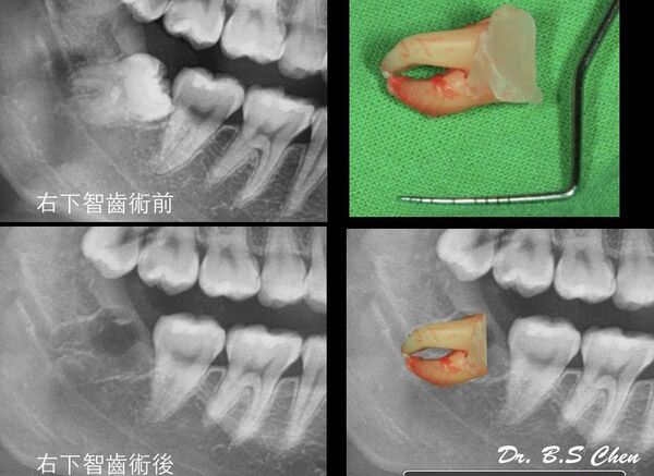 微創智齒手術案例分享