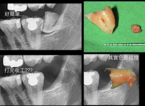 微創智齒手術案例分享