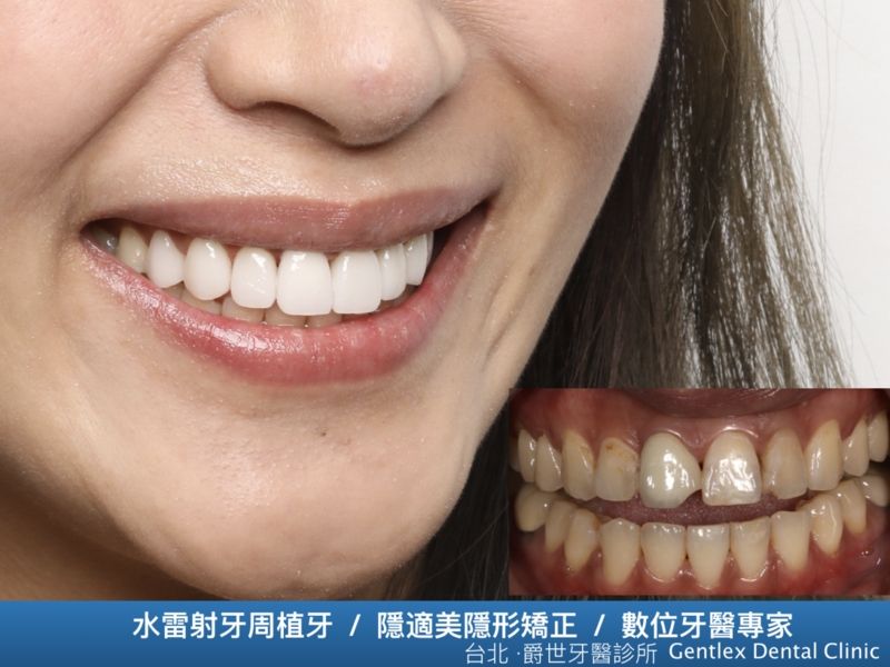 微笑美學全瓷貼片