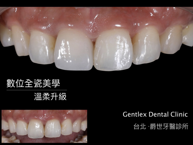 數位擬真全瓷冠