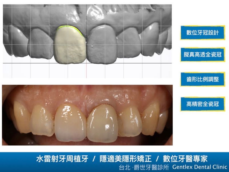 數位高透全瓷假牙