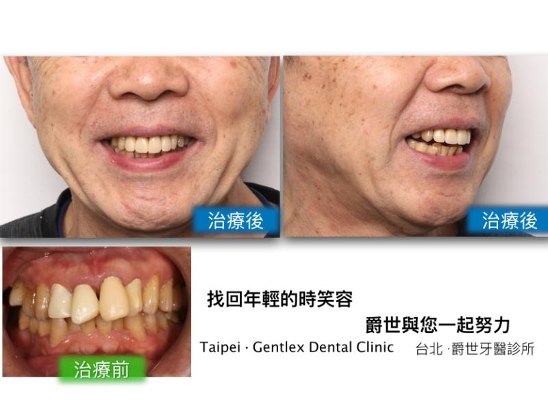 前牙全瓷美學重現