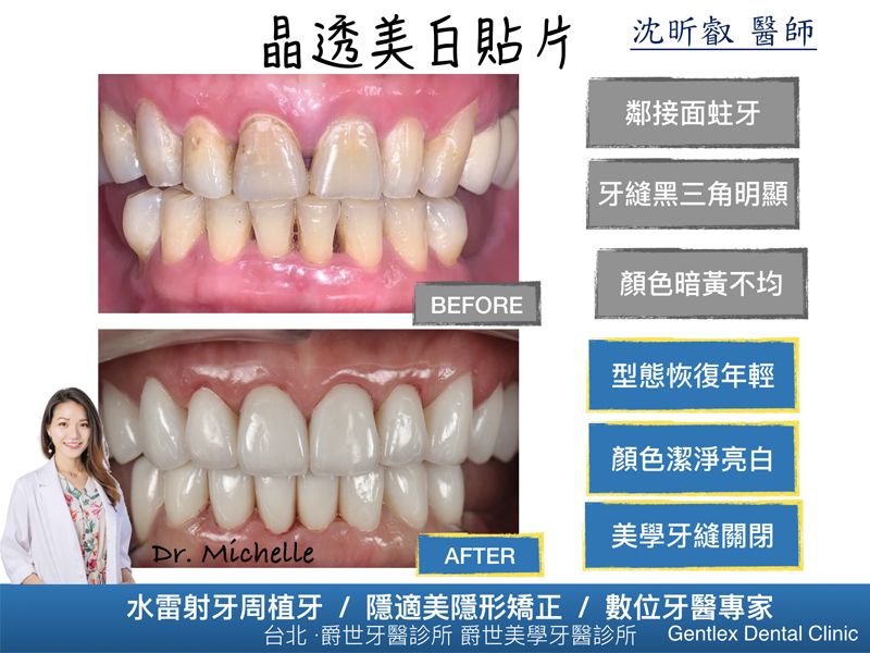 晶透美白全瓷貼片