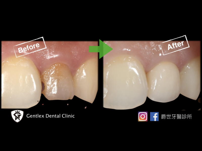 數位擬真全瓷冠