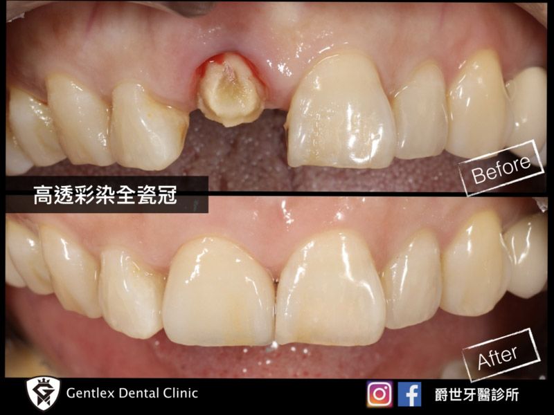 高透彩染全瓷冠